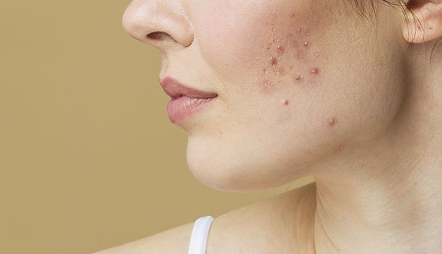 El lugar donde aparece el acné indica la forma en la que vives