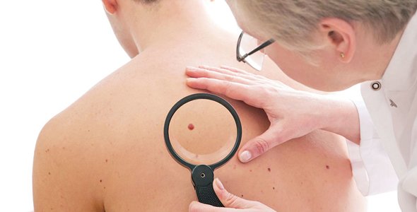 Lunares, ¿en qué momento deben preocuparnos?