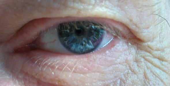 Nuevo medicamento para la degeneración macular asociada a la edad