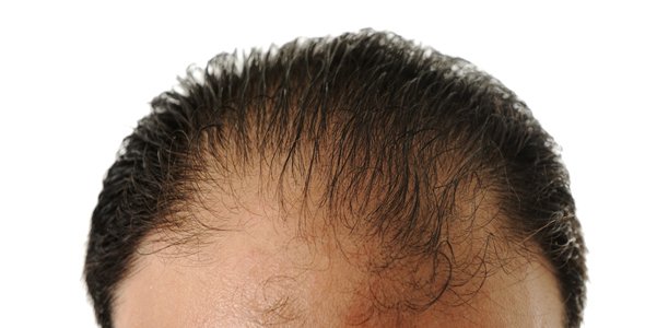 Hallan fuente ilimitada de células madre humanas para curar calvicie