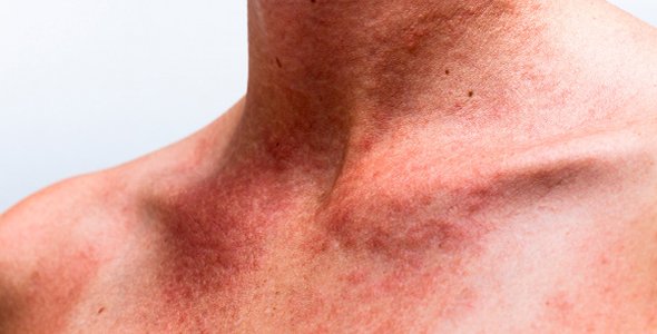 ¡Cuidado con la alergia al sol!