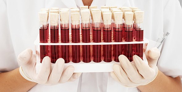 El alzhéimer podrá diagnosticarse con un simple análisis de sangre