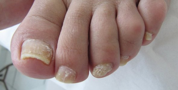 Remedios caseros para hongos en las uñas