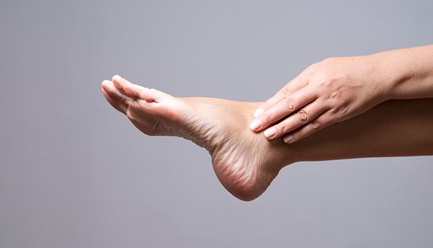 Si tienes callos, estos remedios naturales te ayudarán a desaparecerlos