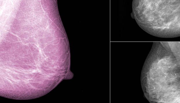 Descubren fármaco para frenar progresión de cáncer de mama más agresivo