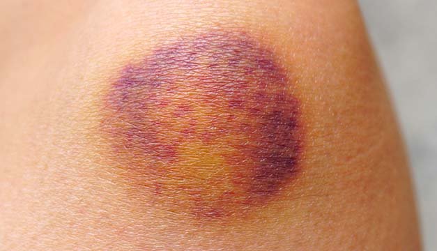 La hemofilia, una enfermedad que no hay que tomar a la ligera