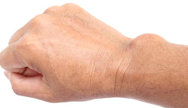 Los sobrehuesos, tumores benignos que pueden causar molestias