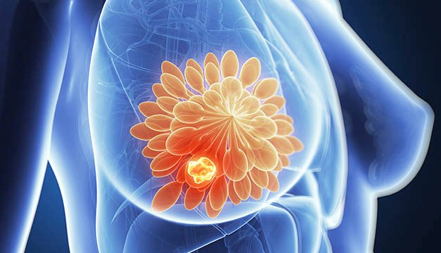 Tratamientos para el cáncer de seno implementados en el país