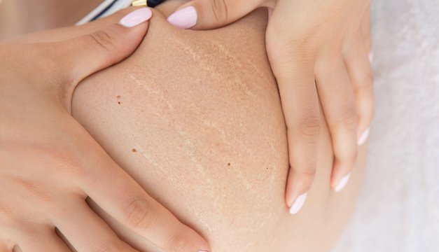 ¿Cómo prevenir las estrías?