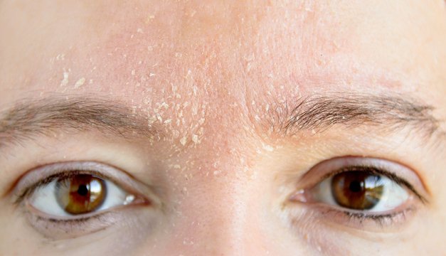 Dermatitis seborreica: El 3% de la población se ve afectada con esta enfermedad