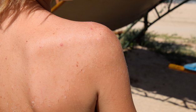 Rosácea: Lo que debes saber si tu rostro luce rojo