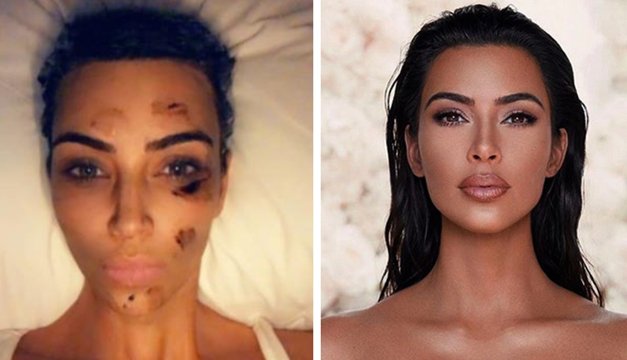 Mira cuáles son los cuidados que tiene Kim Kardashian en el padecimiento de la psoriasis