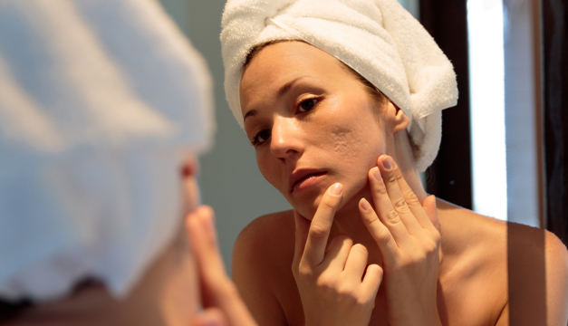 Acné: el padecimiento de la piel más común