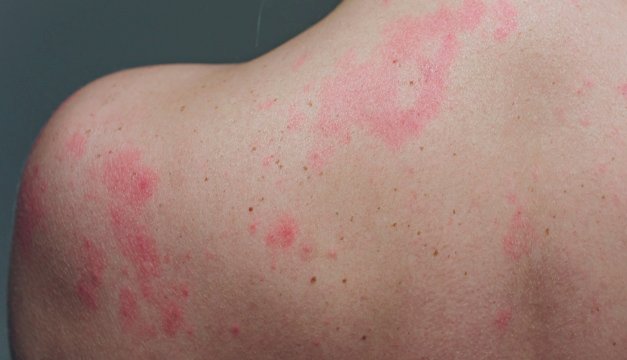 Cómo actuar ante un shock anafiláctico