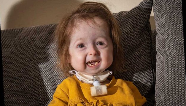 Displasia mandibuloacral: el envejecimiento de una niña británica