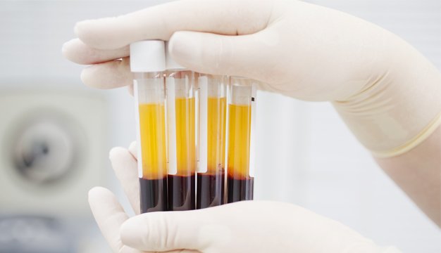 ¿Por qué el plasma de pacientes recuperados de COVID19 beneficia a los contagiados?