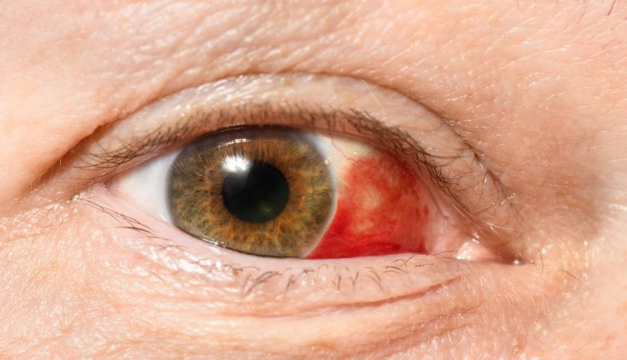 ¿Has tenido un derrame ocular? Aquí te contamos qué hacer