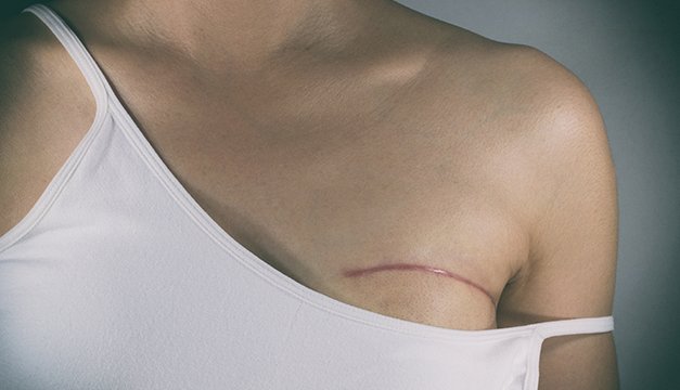 La mastectomía, ¿un método preventivo en El Salvador?