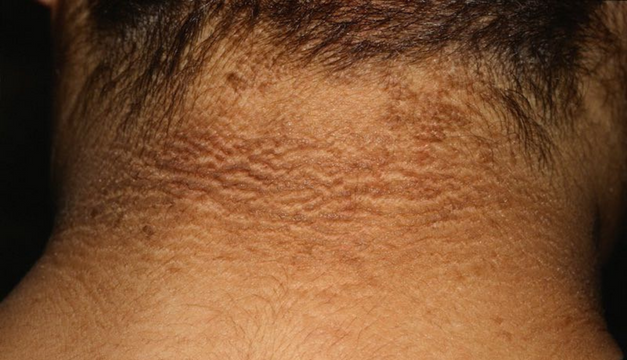 Resistencia a la insulina: puntos para poner atención