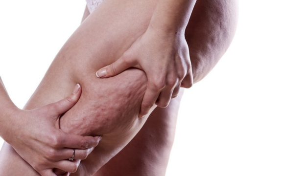 ¿Tienes retención de líquidos? Sigue estos tips para evitarlo