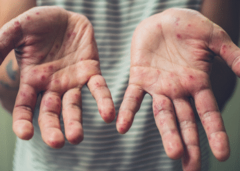 Advierten que la enfermedad Boca-Mano-Pie puede transmitirse antes de dar síntomas y tras su curación