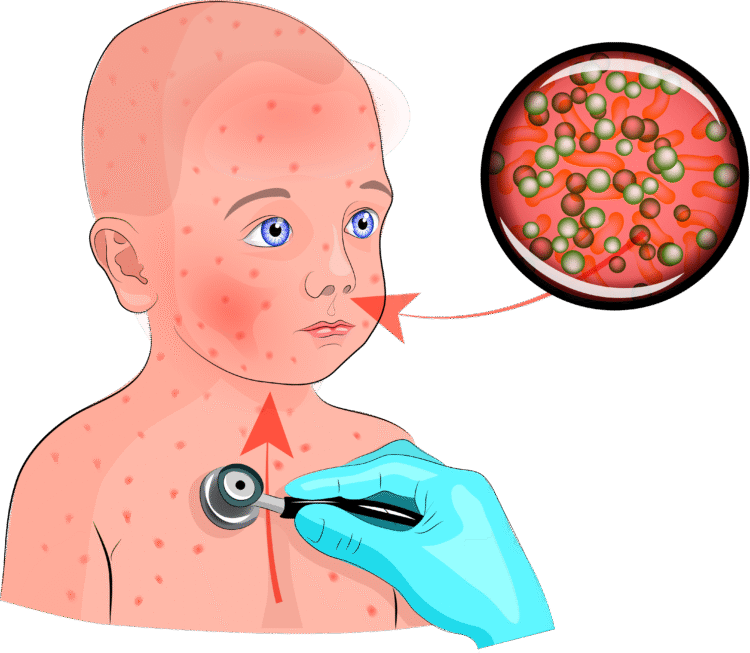 Estamos frente a una epidemia de sarampión, ¿por qué EEUU, Europa y Asia Central están en alerta?
