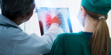 Cáncer de pulmón: la detección temprana puede cambiar el pronóstico